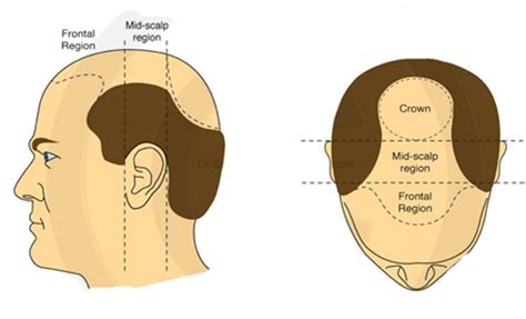 hair transplant crown growth time | Crown Hair Restoration