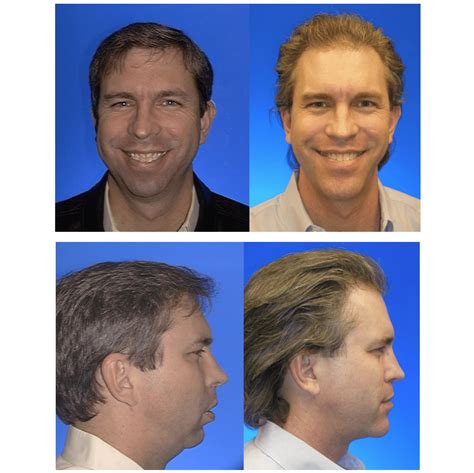 Before and After Photos Maxillofacial Surgery - Larry M. Wolford, DMD