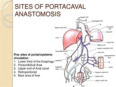 portacaval anastomosis