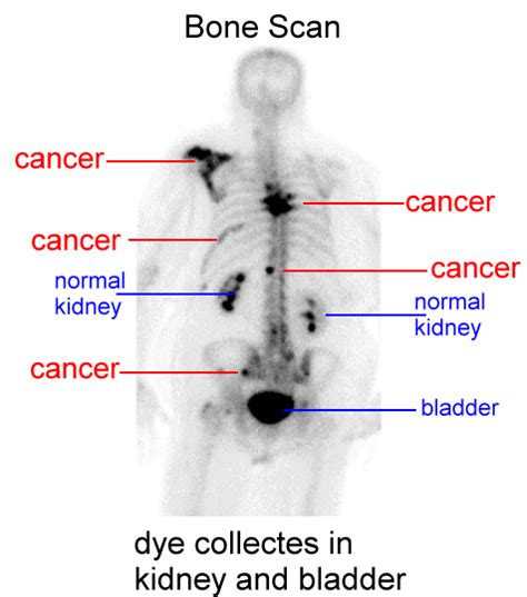 Bone Metastases Images and Xrays