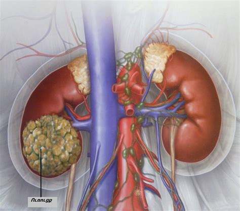 Surgery for kidney cancer | General center | SteadyHealth.com