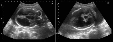 Prenatal ultrasound diagnosis of holoprosencephaly and associated ...