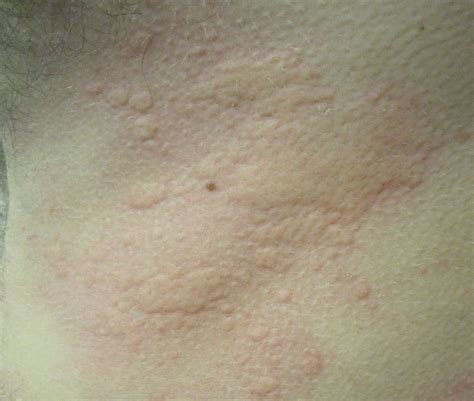 Acute Urticaria : Emergency Care BC