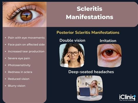 Scleritis Anterior Posterior And Nodular Scleritis Causes Symptoms | My XXX Hot Girl