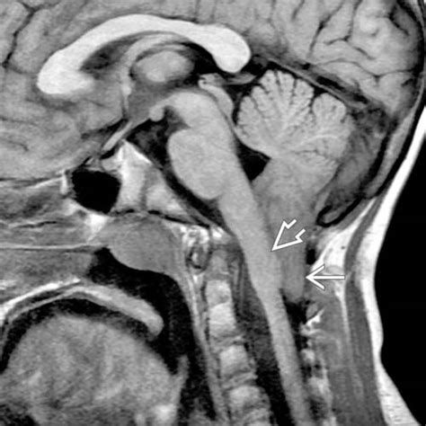 Complex Chiari | Radiology Key