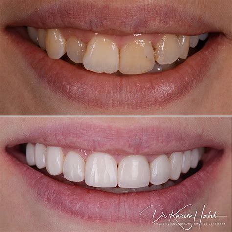 Before and After Photos | Porcelain Veneers Sydney, Cosmetic Dentistry Sydney, Dental Implants ...