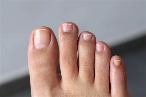 Nail Fungus - Causes, Symptoms And Treatment - 2024 Guide - Demotix.com