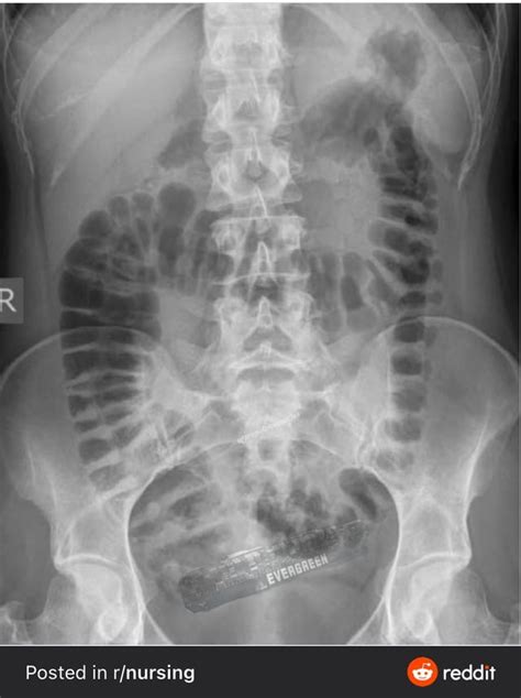 Face of the Giant Panda sign? : Radiology