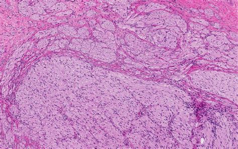 Neuroma Histology