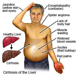 Liver Pain Symptoms Location