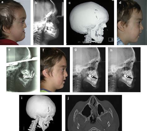 Crouzon Syndrome Before And After