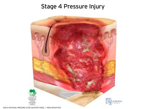 NPTE 2019 Changes: Integumentary Pressure Injury Classifications