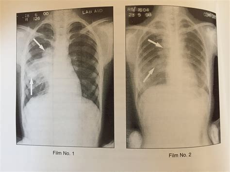 XRAYS OF PRIMARY TUBERCULOSIS