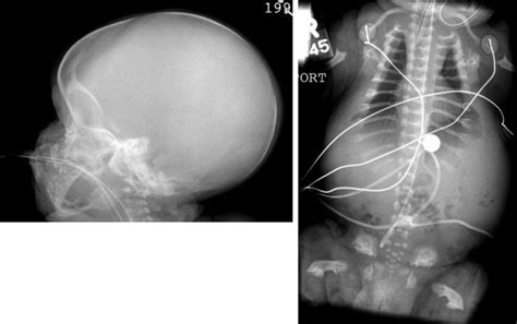 Craniodiaphyseal Dysplasia Skull