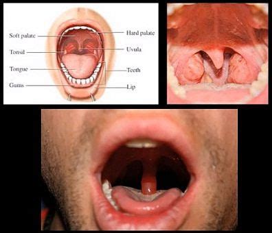 Uvula Infection Treatments