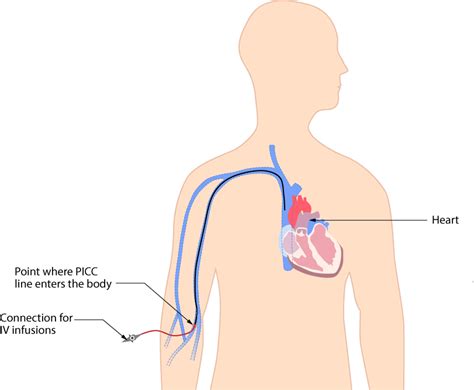 8.2 Intravenous Fluid Therapy – Clinical Procedures for Safer Patient Care