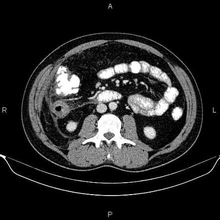 Perforated appendicitis | Radiology Case | Radiopaedia.org