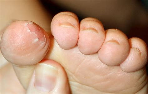 Skin Peeling on Feet - Symptoms, Causes, Treatment, Remedies