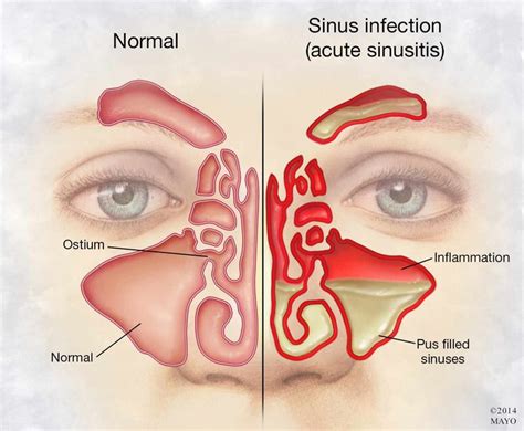 illustration of person's face with sinus infection and inflammation ...