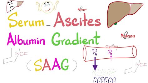 Serum Ascites Albumin Gradient (SAAG) | Peritoneal Effusion | Lab 🧪 - YouTube