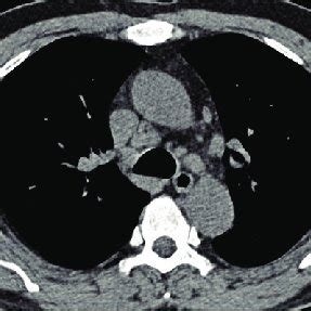 Axial view of CT scans demonstrating the mediastinal lymphadenopathy.... | Download Scientific ...