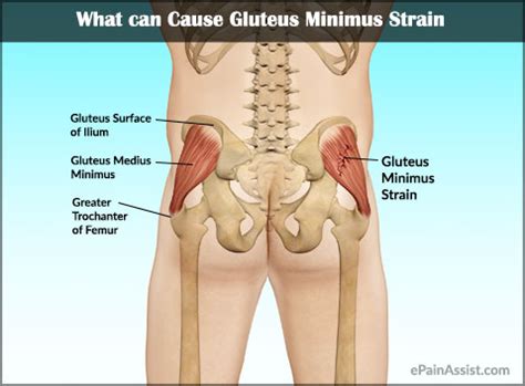 Gluteus Minimus Strain|Causes|Symptoms|Treatment|Recovery