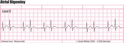 ECG Educator Blog : Atrial Bigeminy