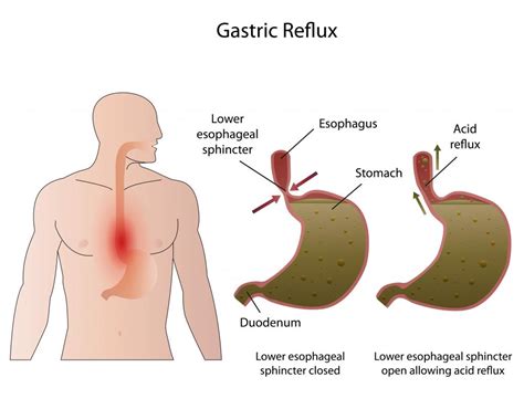 What is a Food Bolus? (with pictures)