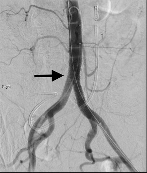 Cureus | Endoleak and Pseudoaneurysm Formation in the Setting of Stent Graft Infection Following ...