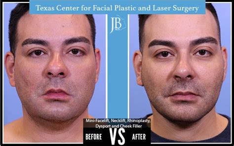 Facelift for Men | San Antonio | Dr. Jose Barrera