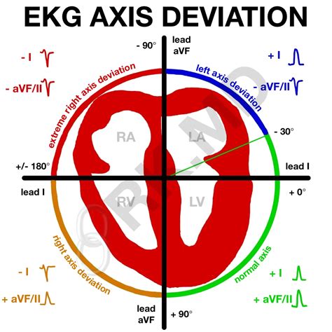 EKG Axis Deviation | RK.MD