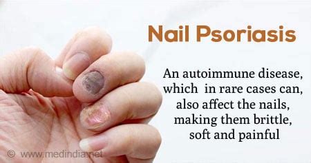 Nail Psoriasis: What It Is, Causes, Nail Pitting, Treatment, 53% OFF