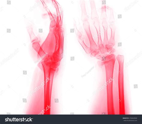 Xray Photos Hand Bone Fracture Patients Stock Photo 376842844 ...