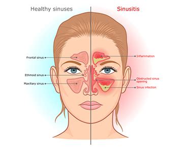 A Sinus Fungal Ball Causes Problems Galore | Cherokee Scout, Murphy, North Carolina