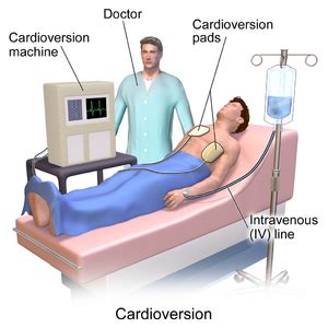 Atrial Fibrillation - Physiopedia