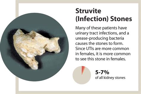 Kidney stones - a marker of overall kidney health - News | UAB