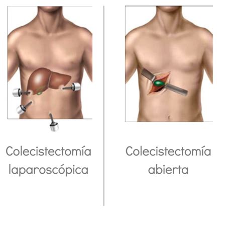 colecistectomia