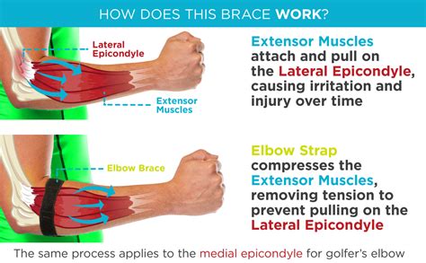 Epicondylitis Brace | Elbow Strap for Medial & Lateral Epicondyle Pain