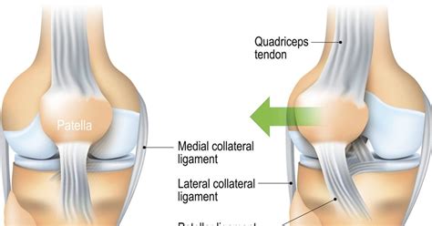 Causes, Symptoms, and Treatments of Patellar Dislocation - Facty Health