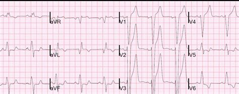 STEMI