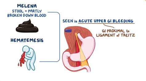 Understanding Bloody Vomit: Causes, Symptoms, and Urgent Care