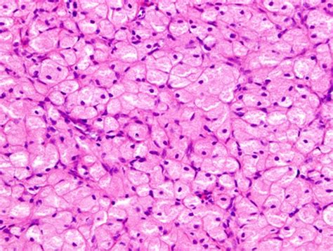 Congenital Epulis Histology