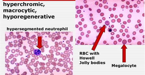 Macrocytic Anemia - Causes, Symptoms & Macrocytic Anemia Treatment