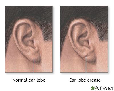 Earlobe creases Information | Mount Sinai - New York