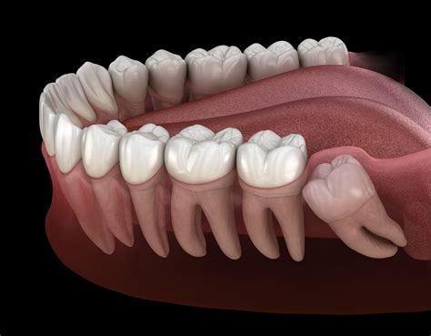 Molars and Wisdom Teeth: Function and Problems