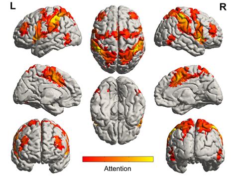 Music activates regions of the brain spared b | EurekAlert!