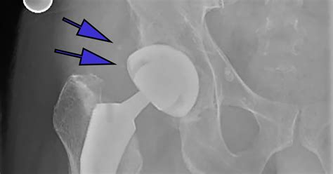 Incidence of Heterotopic Ossification in Direct Anterior Approach to Total Hip Arthroplasty with ...