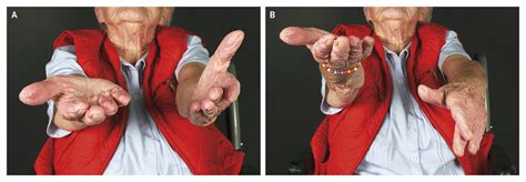 Pronator Drift | NEJM