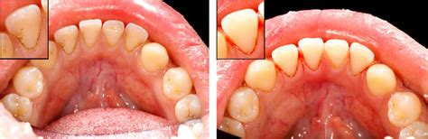 Periodontal Disease - Rigby Dental - Cedar Creek Dental