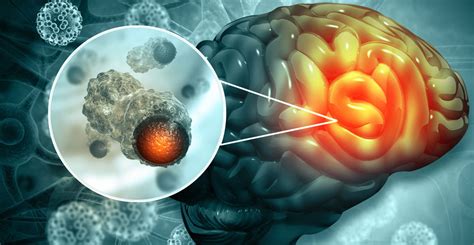 Potential treatment for aggressive paediatric brain tumour identified through AI - Hospital ...